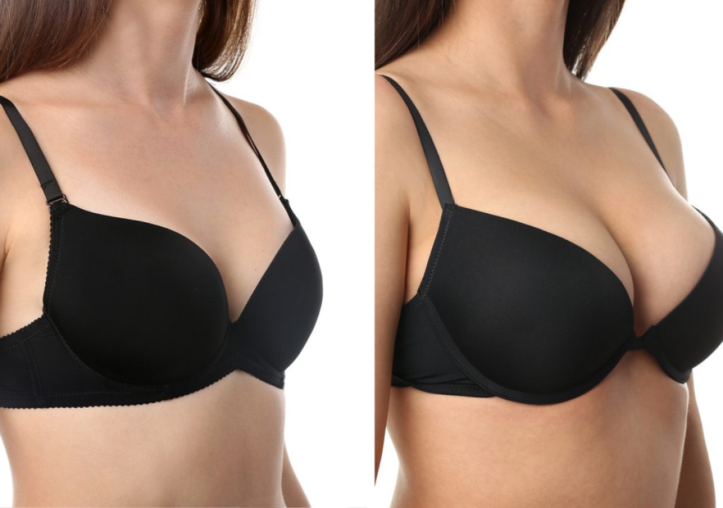 Subtle Lifts, Stunning Results: Breast Enhancement
