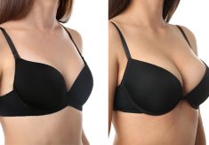 Subtle Lifts, Stunning Results: Breast Enhancement